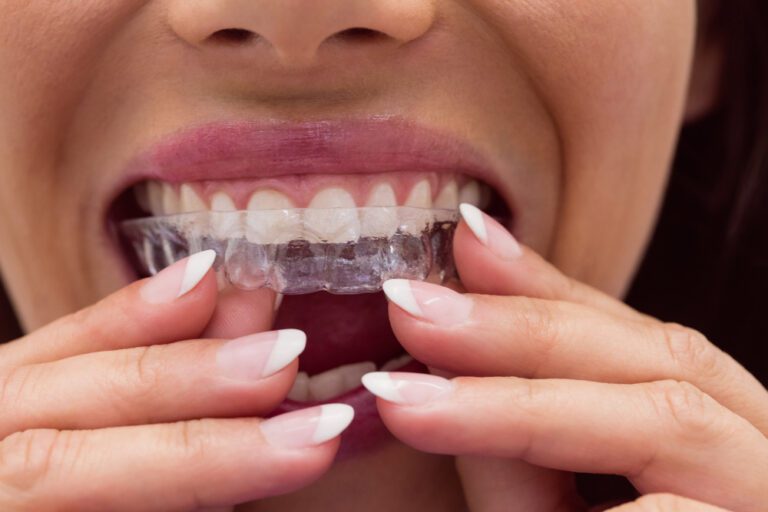 Cum să îți îmbunătățești sănătatea orală cu ajutorul aparatului dentar